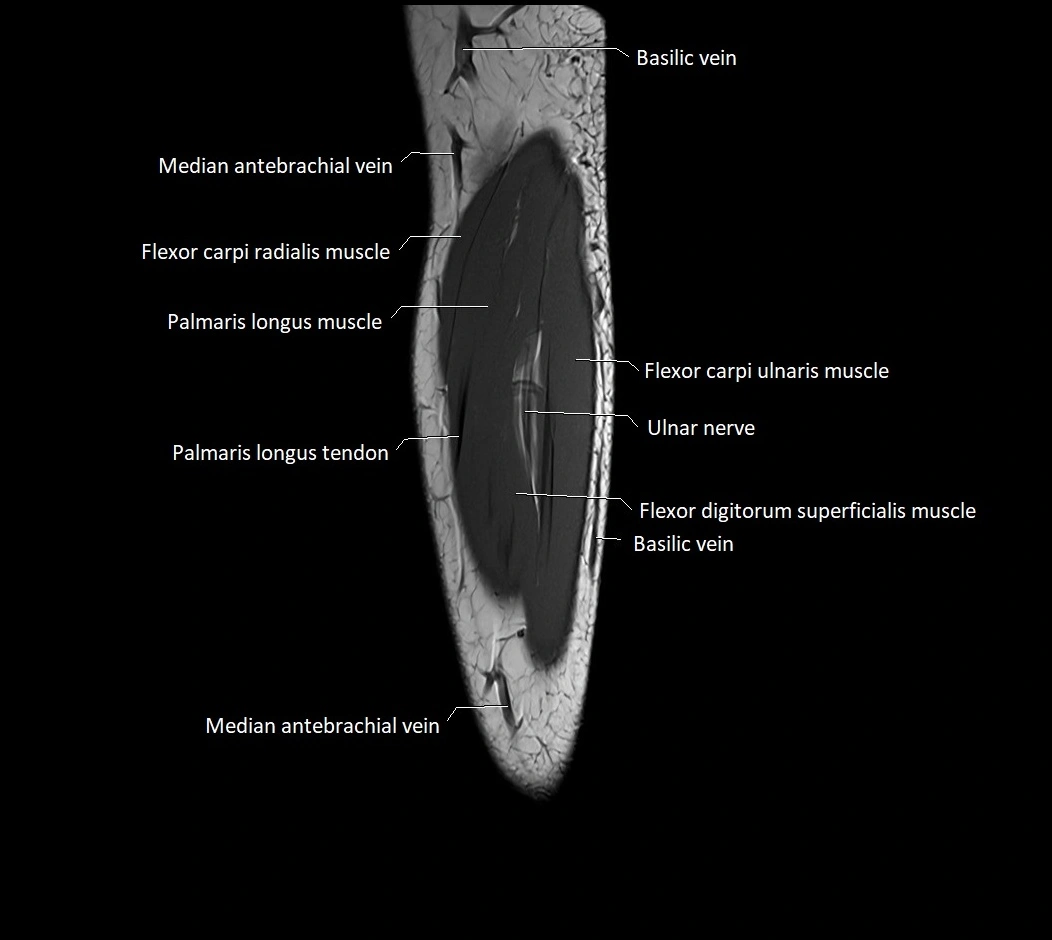 MRI 3T forearm sagittal labelled cross sectional anatomy image 35.webp